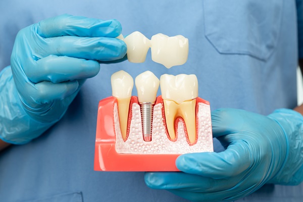 Dental Implants: Replacing A Tooth Root